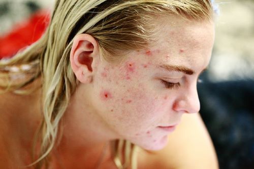 creatine causing acne